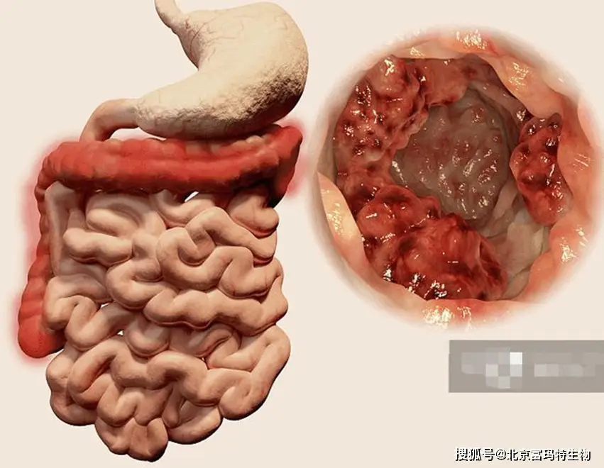 克罗恩怎么引起的_l克罗恩_罗克恩是什么引起的