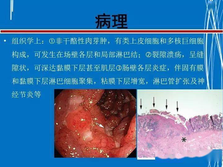 克罗恩病评分表_克罗恩病cdai评分_克罗恩病hbi评分