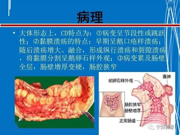 克罗恩病cdai评分_克罗恩病评分表_克罗恩病hbi评分