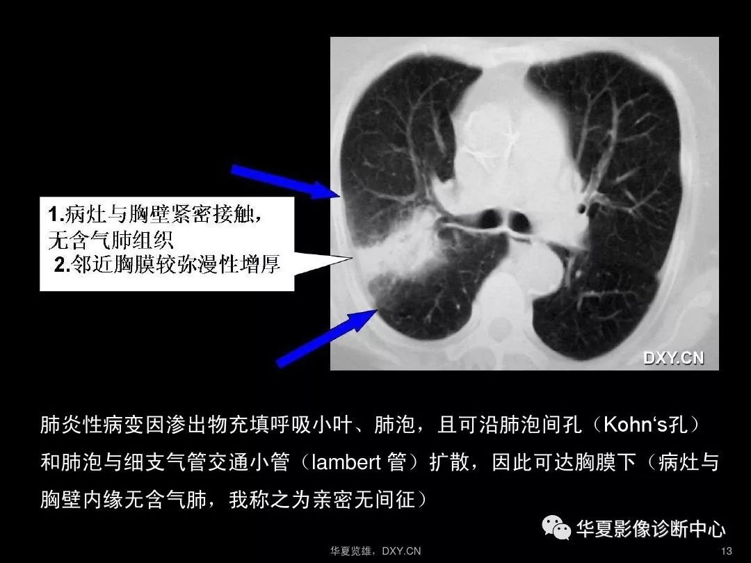 肺炎肺结核最大区别表现_肺炎肺结核严重吗_肺炎和肺结核哪个严重