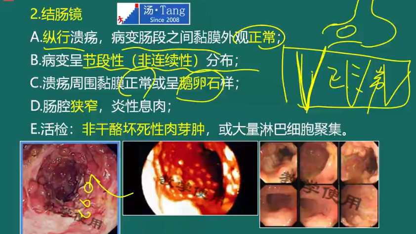 罗克恩病早期症状_克罗恩病克罗恩肠炎治疗_罗克罗恩病