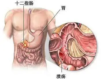 胃中药配方糜烂溃疡治疗方法_胃中药配方糜烂溃疡治疗_胃溃疡胃糜烂中药配方