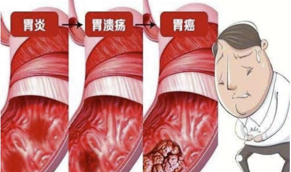 胃溃疡出血的中医治疗_中医治疗胃溃疡大出血_胃溃疡出血中医辩证