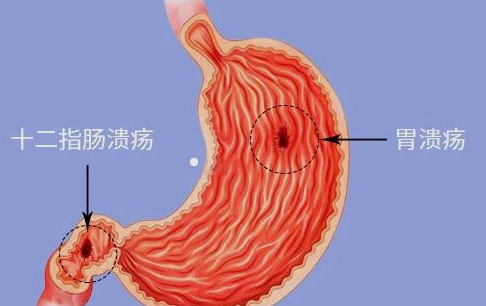 胃溃疡中医治疗方法-中医小达人支招，轻松应对胃溃疡，食疗中药调理双管齐下