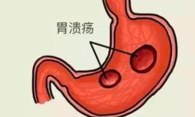胃溃疡中医治疗方法_胃中医治疗方法溃疡效果好吗_胃中医治疗方法溃疡怎么治疗