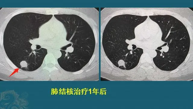 继发性肺结核多久能好-继发性肺结核治疗周期长且可能有副作用，患者需注意这些