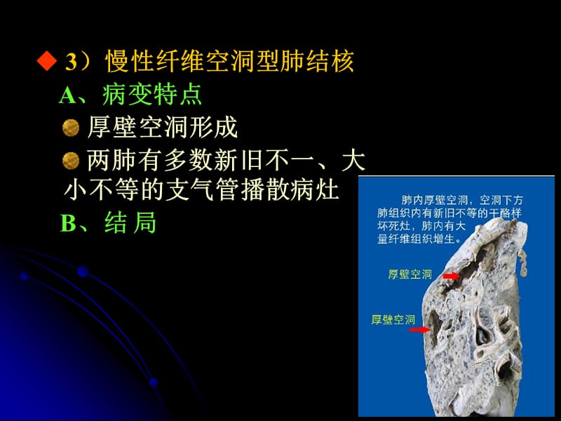 肺结核继发性有传染性吗_继发性肺结核多久能好_肺结核继发性严重吗