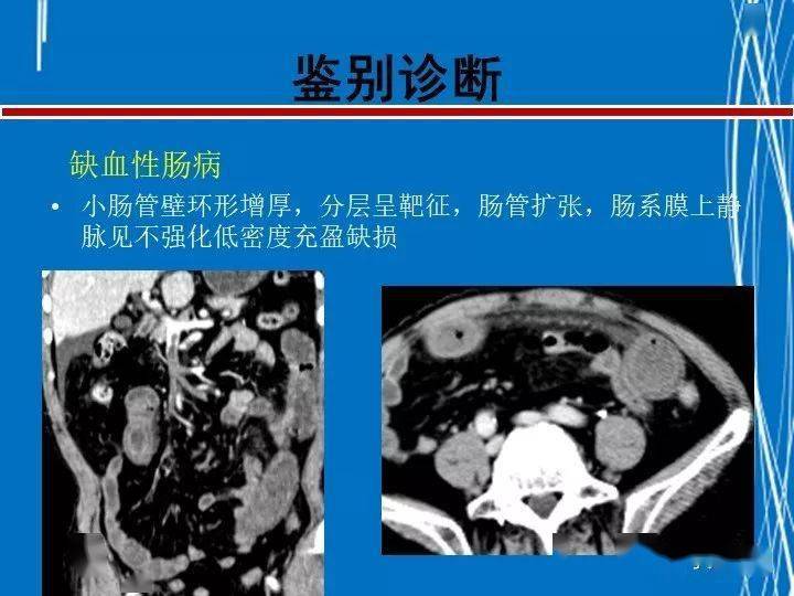 罗克罗恩病的特征性体征_罗克恩病怎么确诊_克罗恩病诊断临床分型