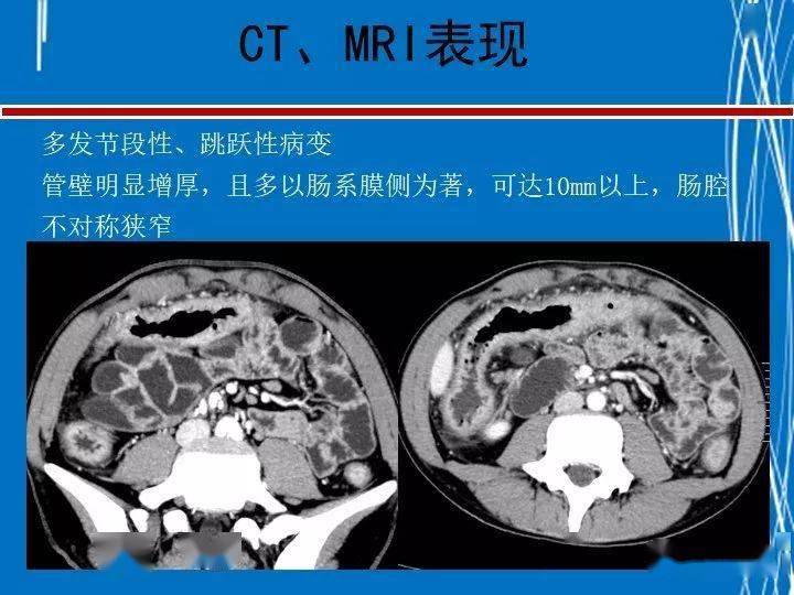 罗克恩病怎么确诊_罗克罗恩病的特征性体征_克罗恩病诊断临床分型