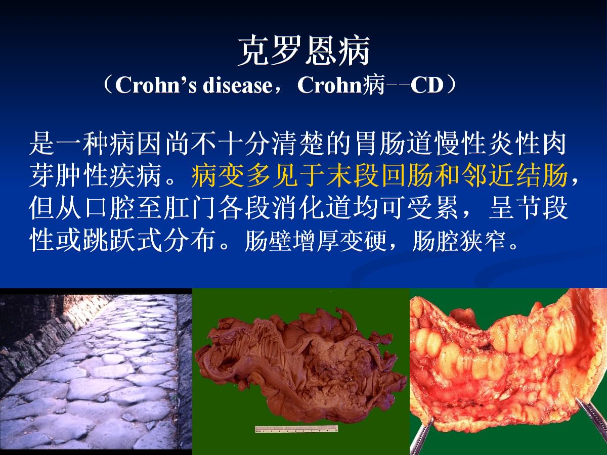 罗克罗恩病的特征性体征_克罗恩病诊断临床分型_罗克恩病怎么确诊