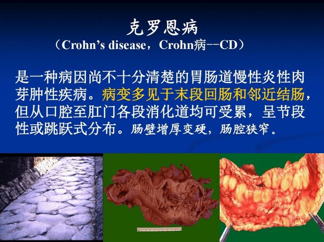 克罗恩病吃什么食物_罗克恩病能治好吗_罗克恩病早期症状