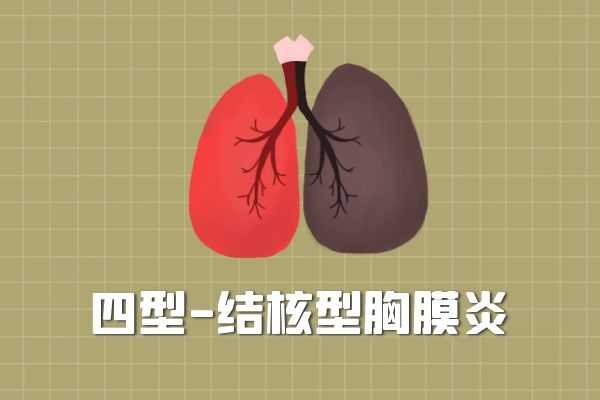 肺传染结核型会复发吗_三型肺结核会传染吗_肺结核传染可能性