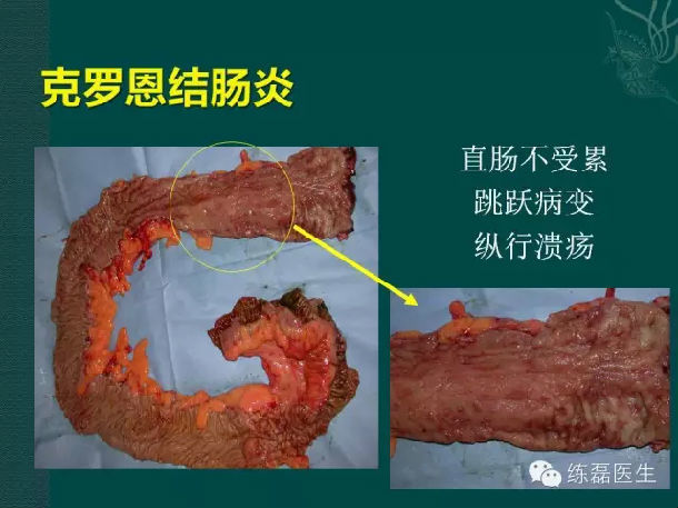 中医治疗克罗恩病_治疗克罗恩的中医药方_中医治疗克罗恩