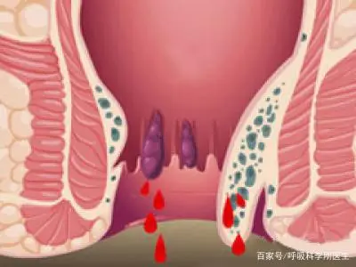 喝酒后大便出血是怎么回事_大便出血是喝酒引起的吗_出血大便喝酒回事后是怎么回事