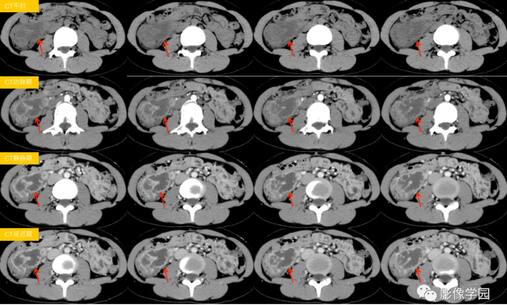 克罗恩病鉴别诊断表格_克罗恩病的鉴别诊断_诊断克罗恩病的检查首选的是