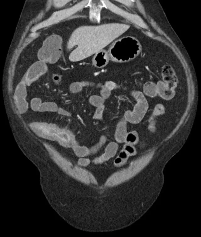 罗克罗恩病的特征性体征_克罗恩病x线表现_课罗恩病