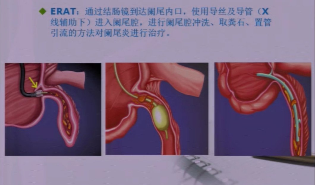 急性化脓性阑尾炎术后护理_急性化脓性阑尾炎术后护理_急性化脓性阑尾炎术后护理
