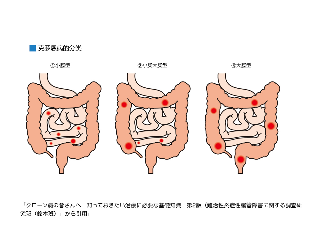 治疗克罗恩的中医药方_中医治疗克罗恩_中医治疗罗恩克病的方法