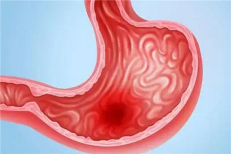 65岁大便出血_老年人大便出血是怎么回事_大便出血是怎么回事老年人