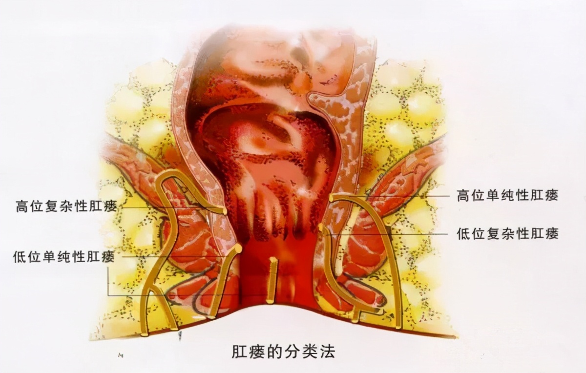 肛瘘切除术后一般几天可以出院_做肛瘘切除手术要多少时间_切除手术做肛瘘时间要多久