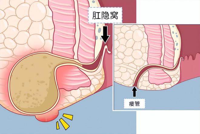 肛瘘手术后多长时间恢复_肛瘘手术后多久能长平_肛瘘手术后多长时间会复发