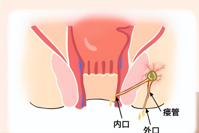 肛瘘手术后多久能长平_肛瘘手术后多长时间会复发_肛瘘手术后多长时间恢复