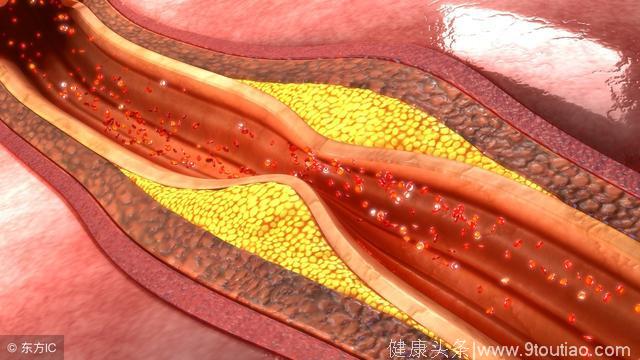 冠心病讨论记录_冠心病病例讨论_冠心病病例讨论记录