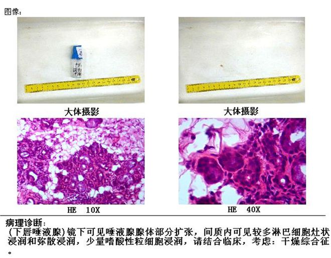 浸润型肺结核怎么治疗_浸润性肺结核治疗_浸润型肺结核治愈