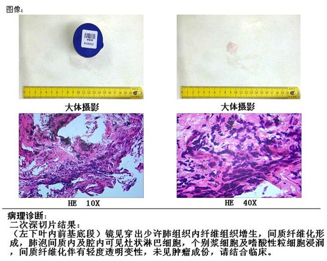 浸润型肺结核治愈_浸润性肺结核治疗_浸润型肺结核怎么治疗