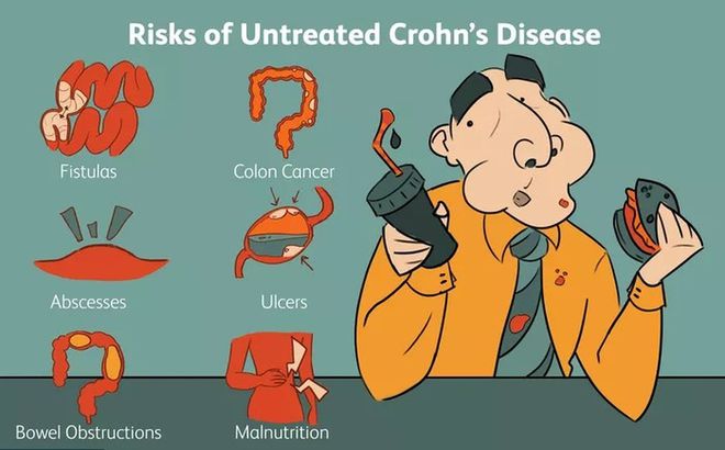 克罗恩打类克能治愈吗_克罗恩打类克到底好不好_克罗恩用类克效果好吗