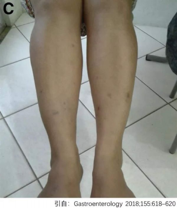 克罗恩病溃疡_克罗恩病溃疡能愈合吗_克罗恩的溃疡什么形状