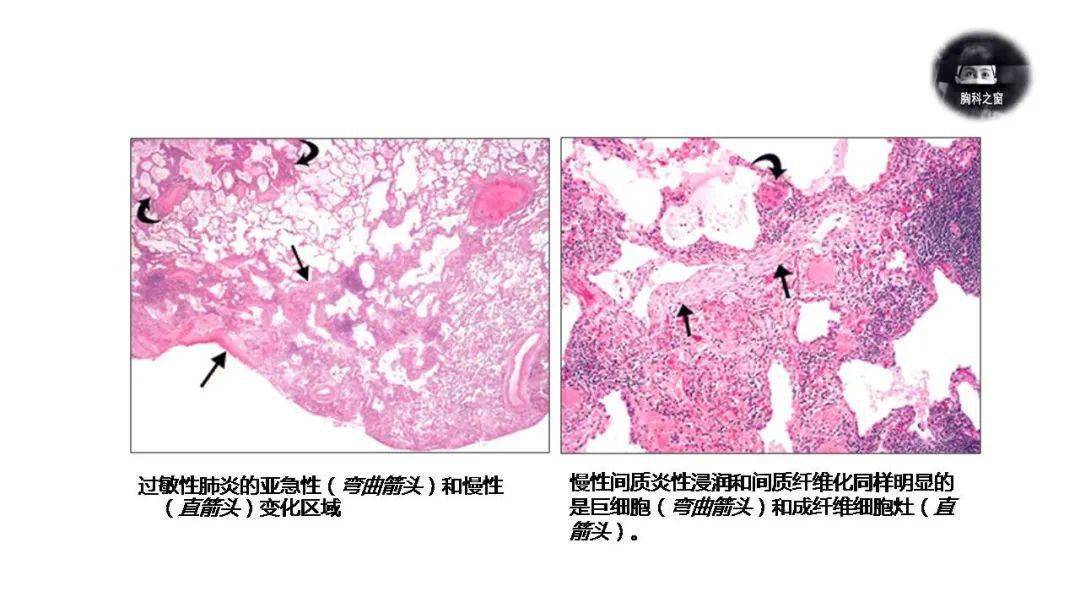肺泡蛋白质沉积_肺泡蛋白沉积_肺泡蛋白质沉积症发病率