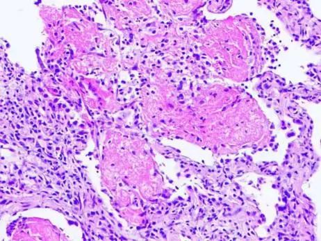 甲强龙治疗儿童肺炎_儿童肺炎甲强龙的作用与功效_小儿肺炎用甲强激素的危害