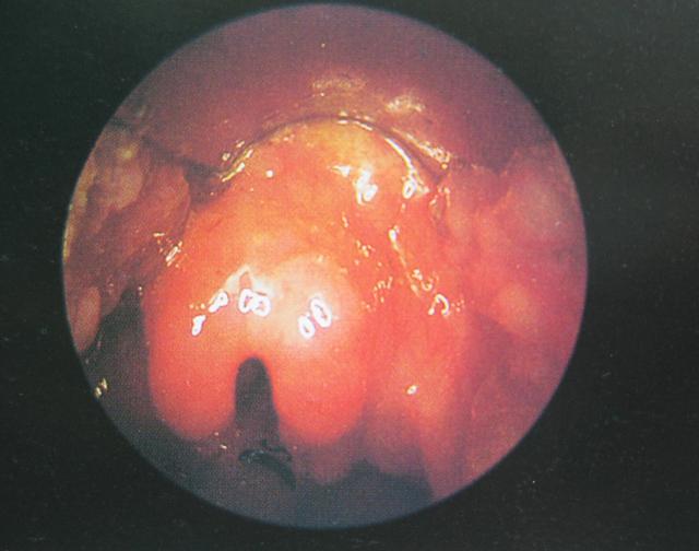 甲强龙治疗儿童肺炎_小儿肺炎用甲强激素的危害_儿童肺炎甲强龙的作用与功效