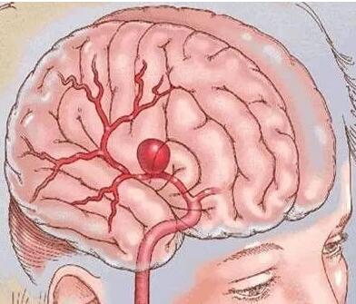 进展脑抗性卒中的表现_抗脑卒中药物进展_进展性脑卒中 双抗