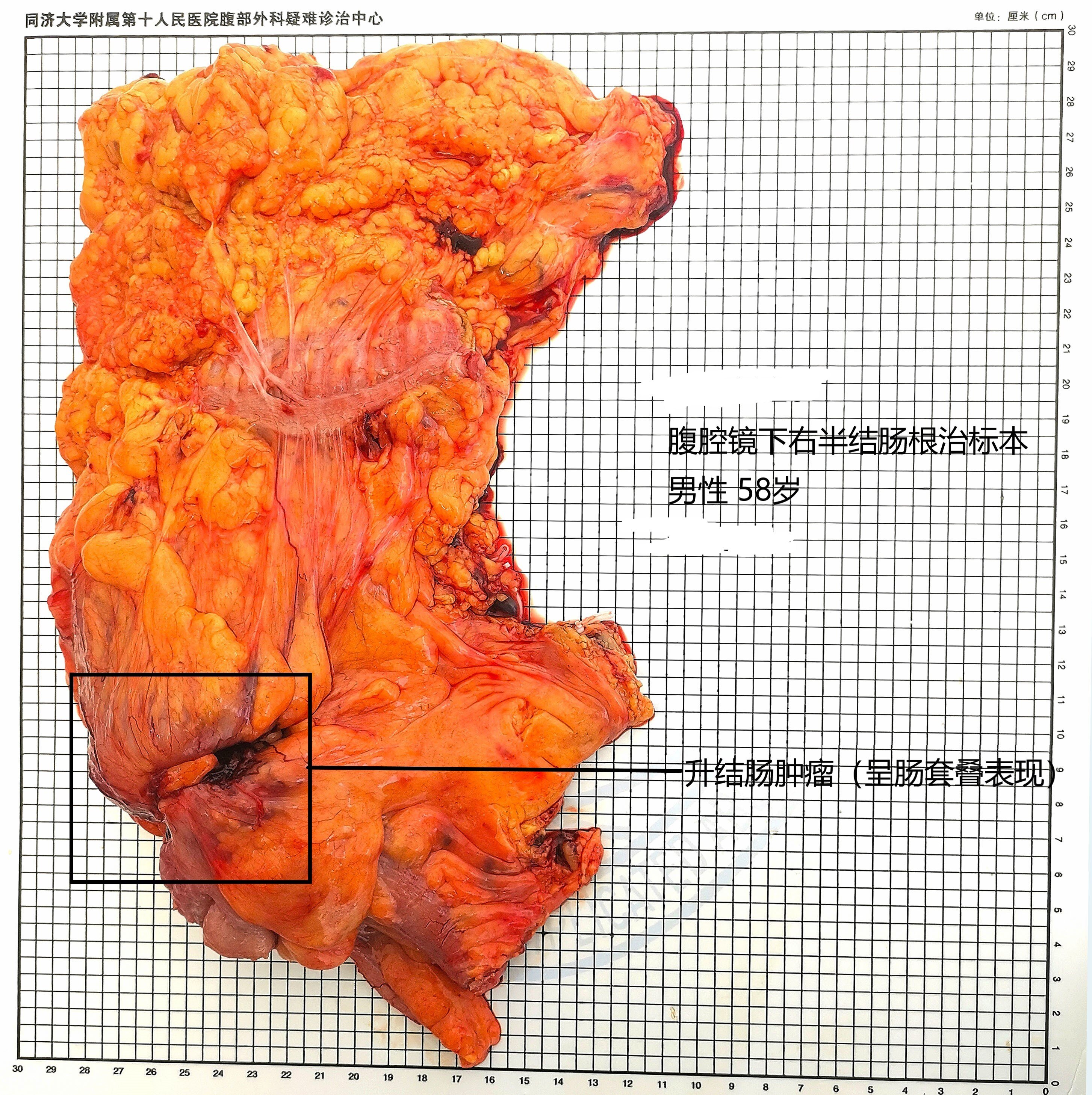 肠套叠的典型ct征象_肠套叠ct图_肠套叠ct描述模板