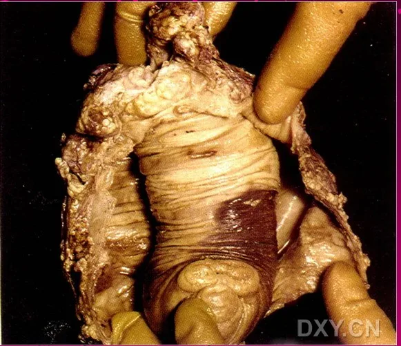 肠套叠ct描述模板_肠套叠ct图_肠套叠的典型ct征象