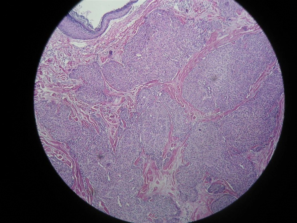 前胸后背疼 背部还有个肿块_前胸后背疼后背起大包_前胸后背肿痛