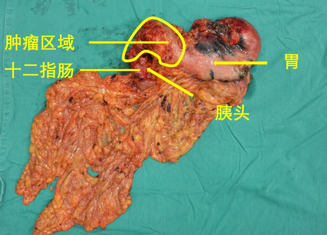 胃癌ct图片怎么看_胃癌ct图片大全_胃癌胃部照片