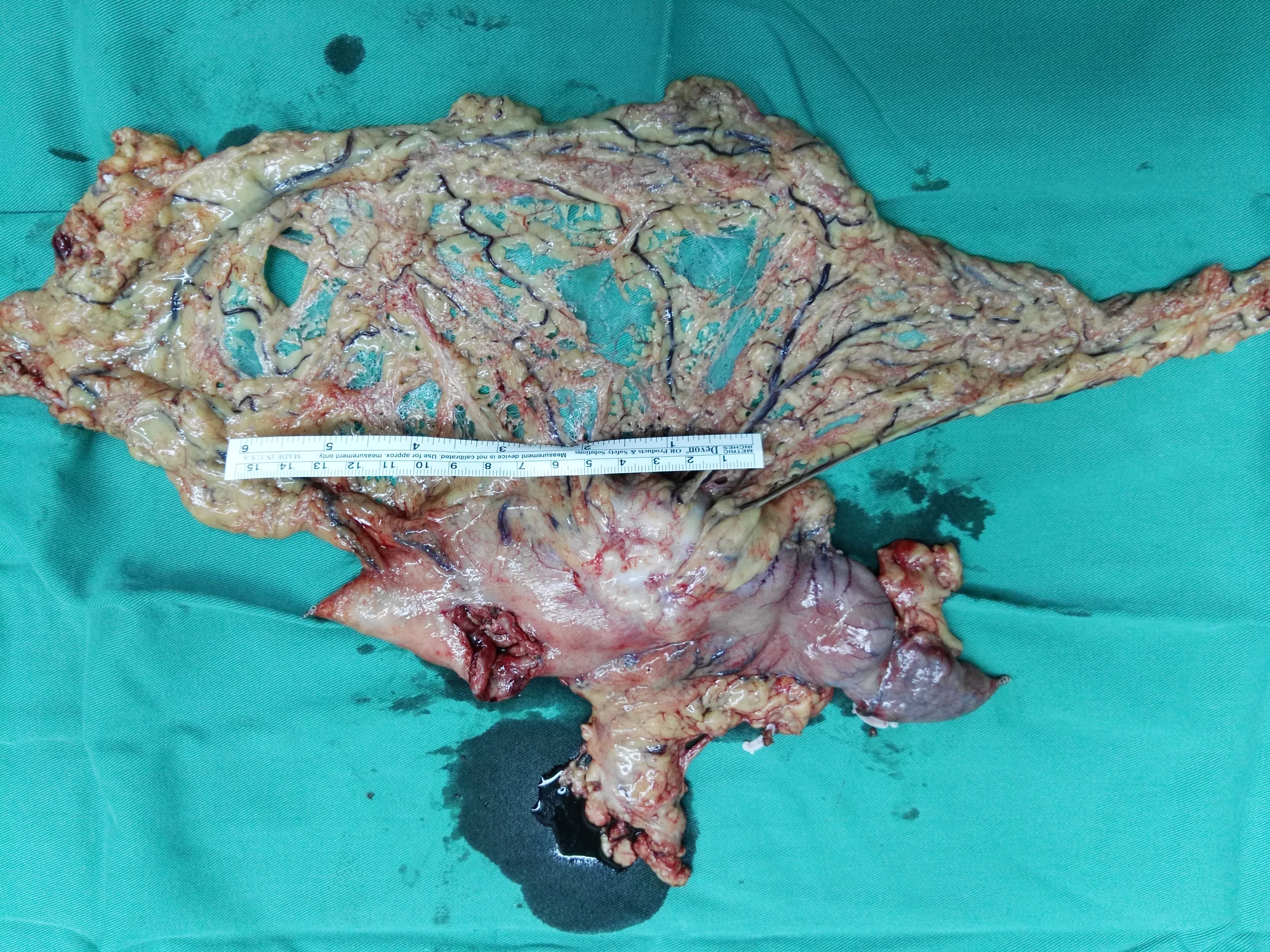 胃癌胃部照片_胃癌ct图片大全_胃癌ct图片怎么看