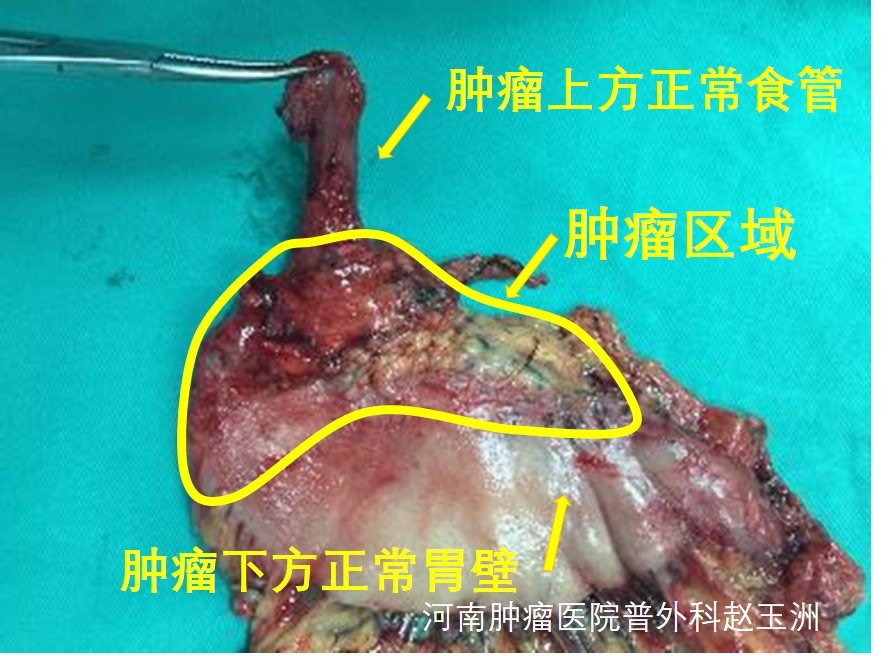 胃癌ct图片大全_胃癌胃部照片_胃癌ct图片怎么看
