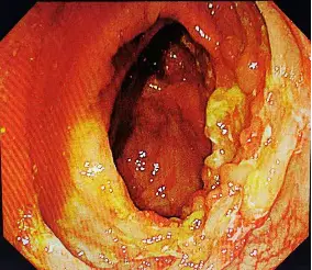 罗克恩病早期症状_克罗恩病诊断//.l_罗克罗恩病的特征性体征