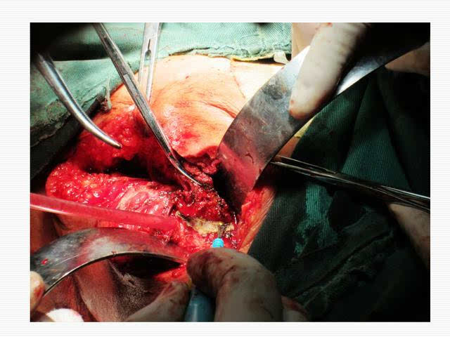 肛瘘切除术要多久_切除手术做肛瘘时间要多长_做肛瘘切除手术要多少时间