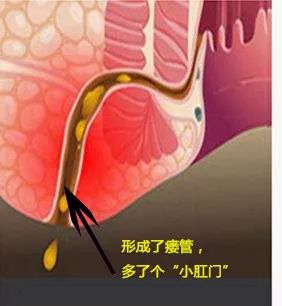 肛瘘切除术要多久_做肛瘘切除手术要多少时间_切除手术做肛瘘时间要多长