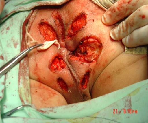 切除手术做肛瘘时间要多长_做肛瘘切除手术要多少时间_肛瘘切除术要多久