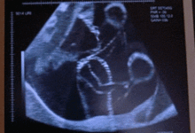 24周做系统b超,孕期24周系统B超的重要性与检查内容