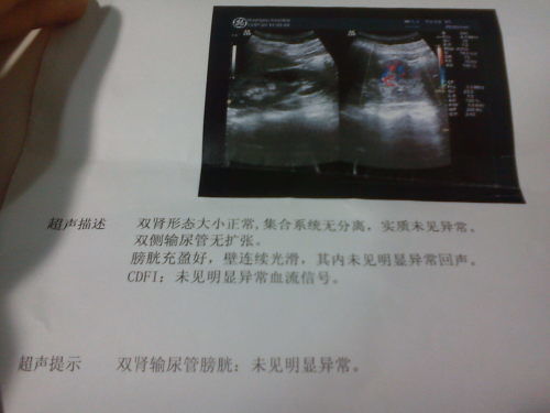 b超检查了泌尿系统,全面了解泌尿系统健康状况
