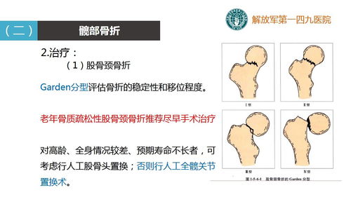 骨质疏松治疗系统,全方位守护骨骼健康