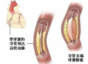 冠脉支架系统,心血管疾病治疗的重要突破