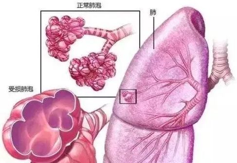 肺系统肺气肿,了解疾病、预防和治疗